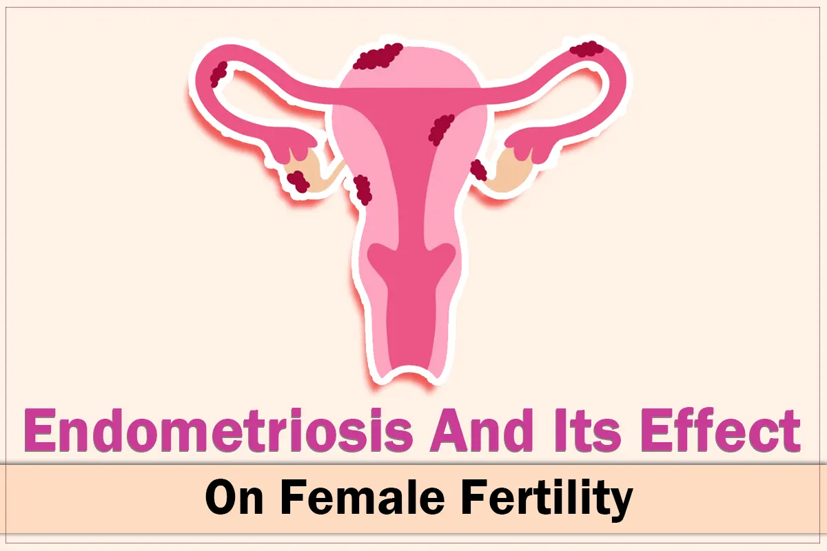 Endometriosis And Its Effect On Female Fertility blog featured image