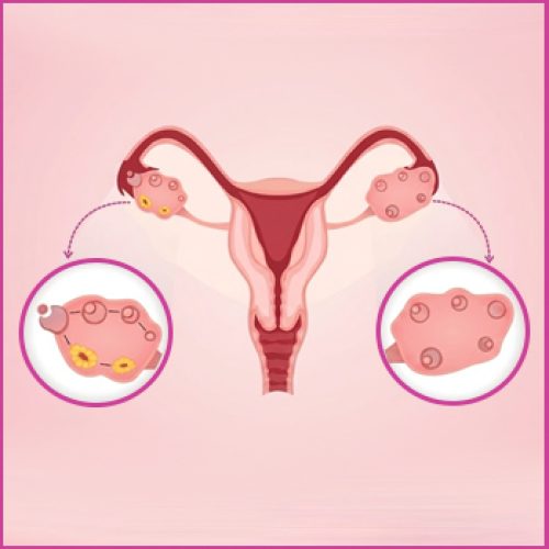 The Diagnosis and Treatment of Primary Ovarian Insufficiency